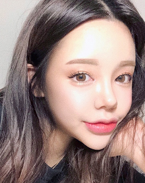 매몰 쌍꺼풀(재수술)+윗트임+뒤밑트임+풀페이스 지방이식