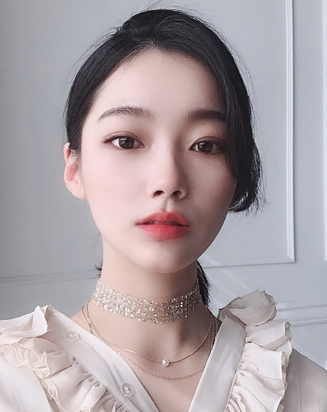 매몰 쌍꺼풀