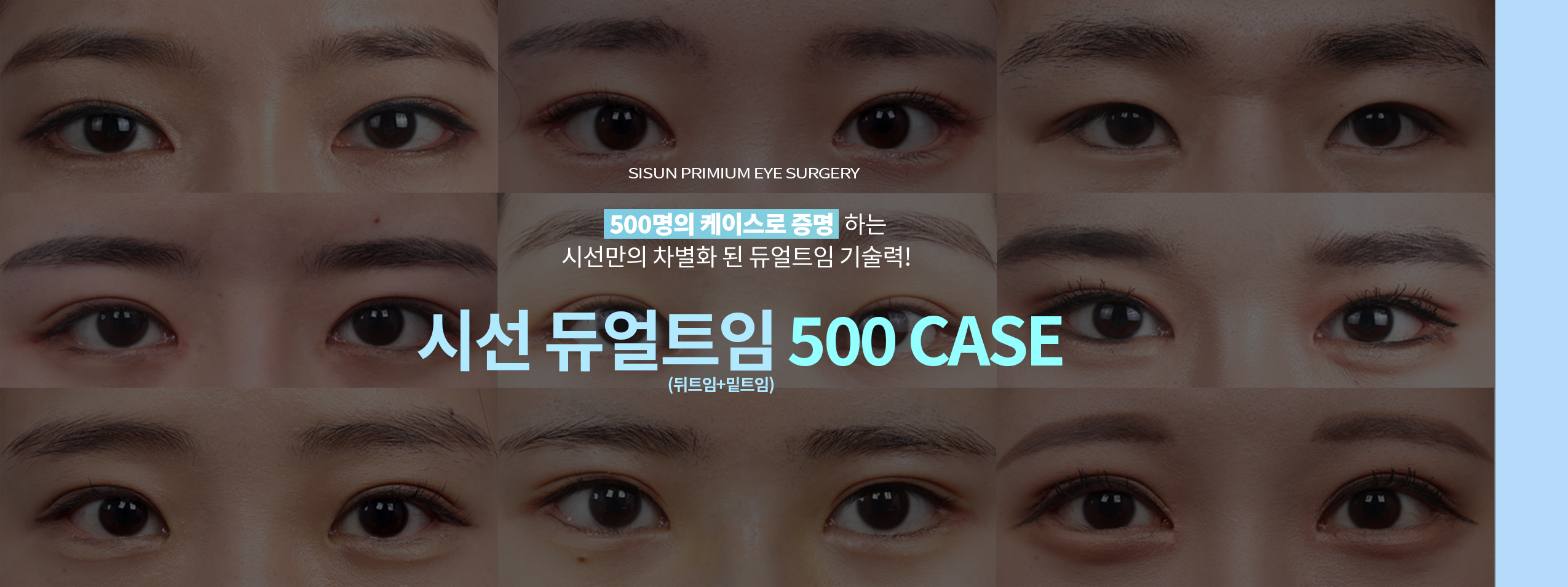 시선성형외과 눈성형 안내