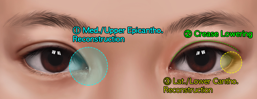 Eye surgery aftercare areas