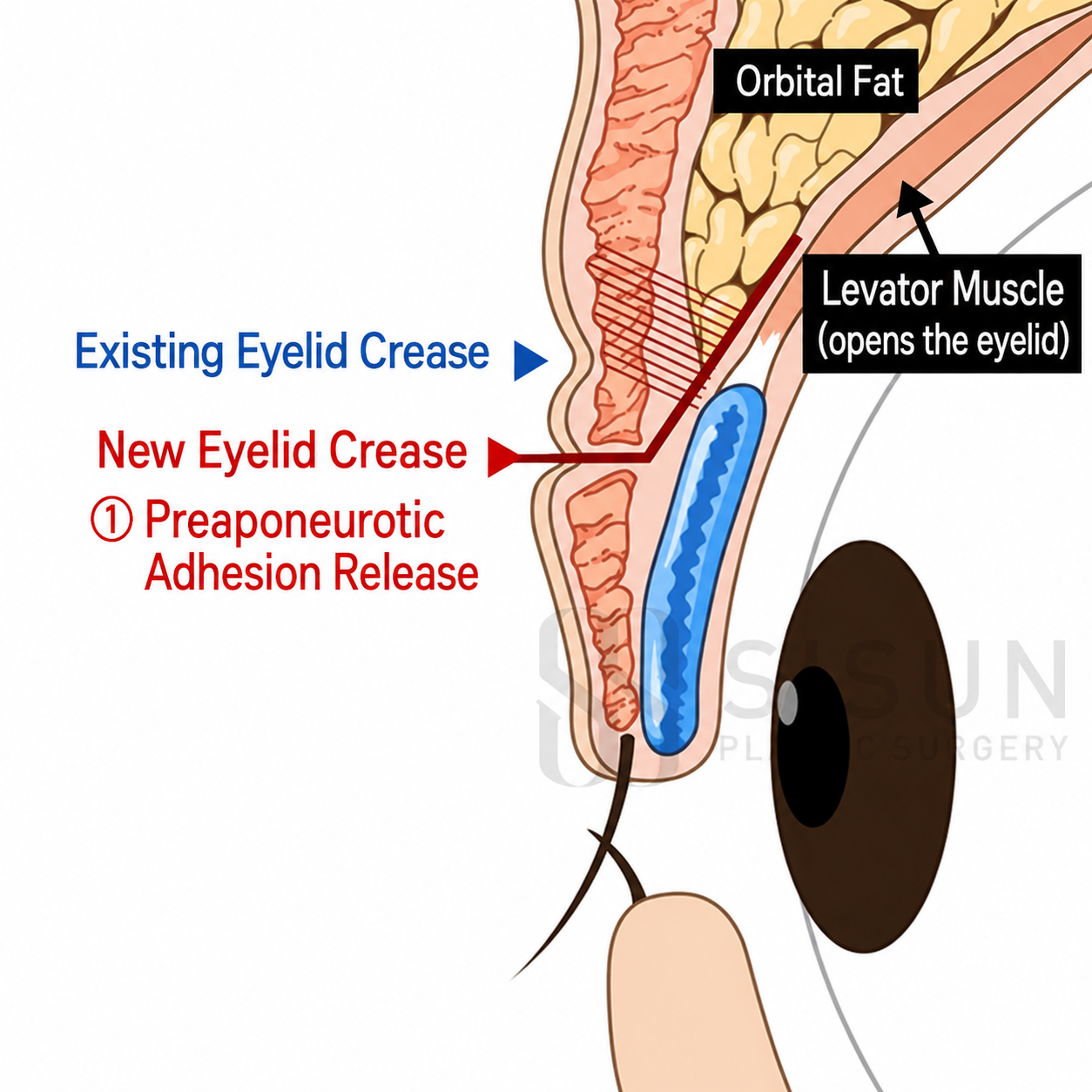 Preaponeurotic adhesion release