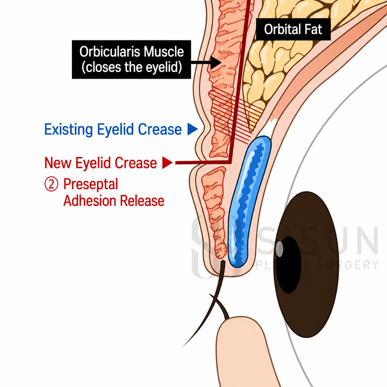 Preseptal adhesion release