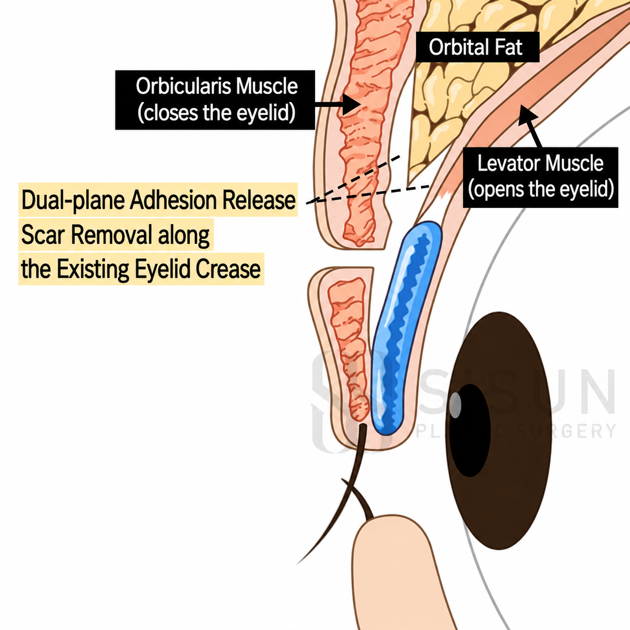 Dual-plane adhesion release and scar removal