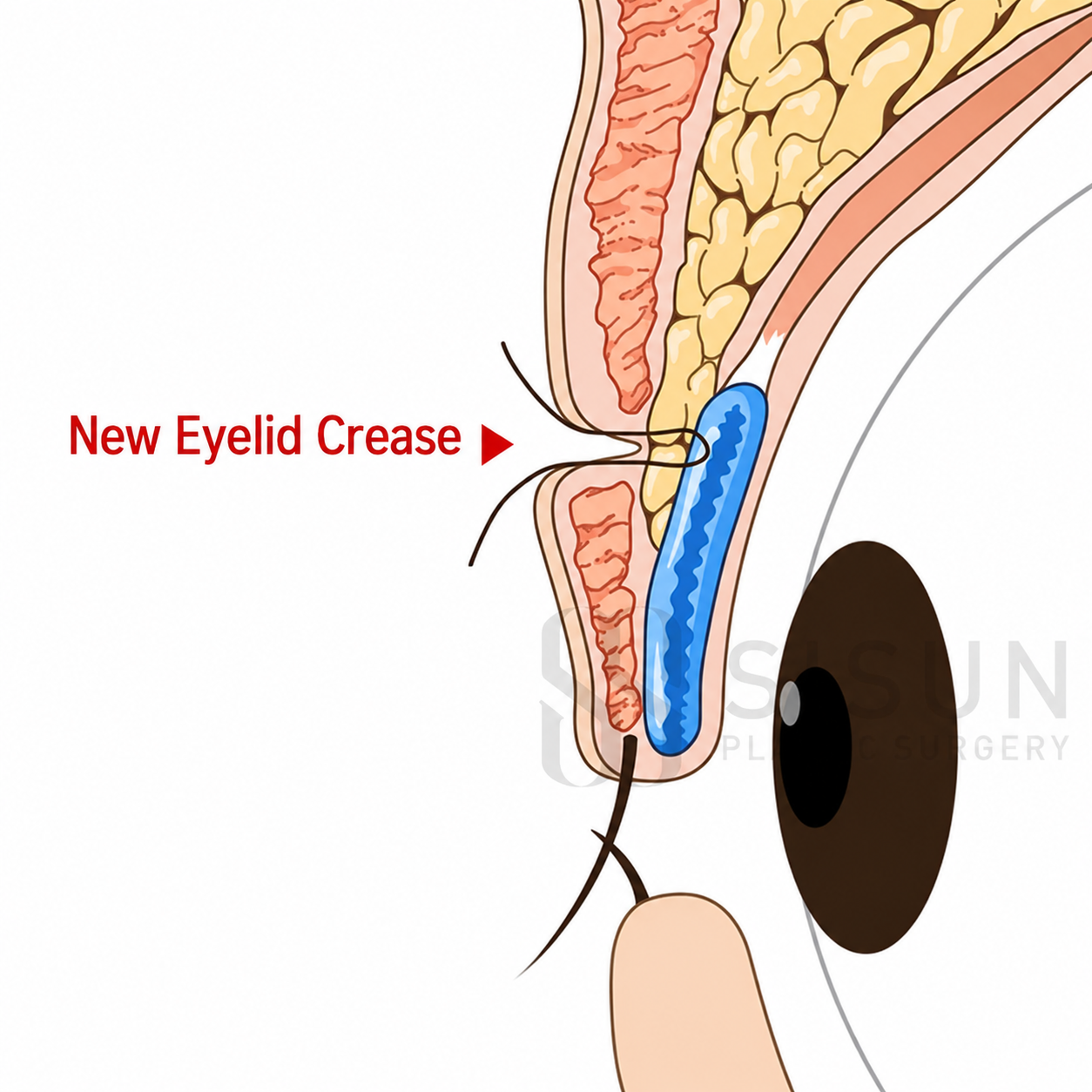 New eyelid crease