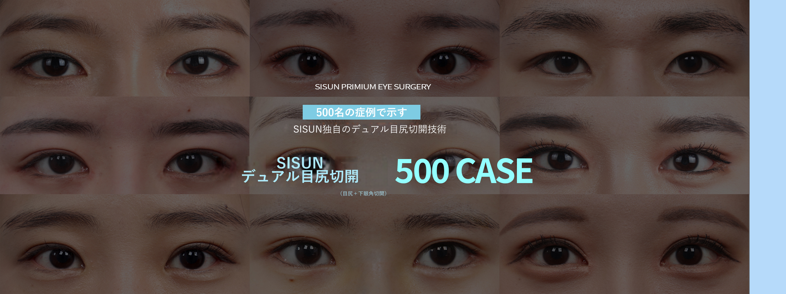 SISUN美容外科の目元整形案内