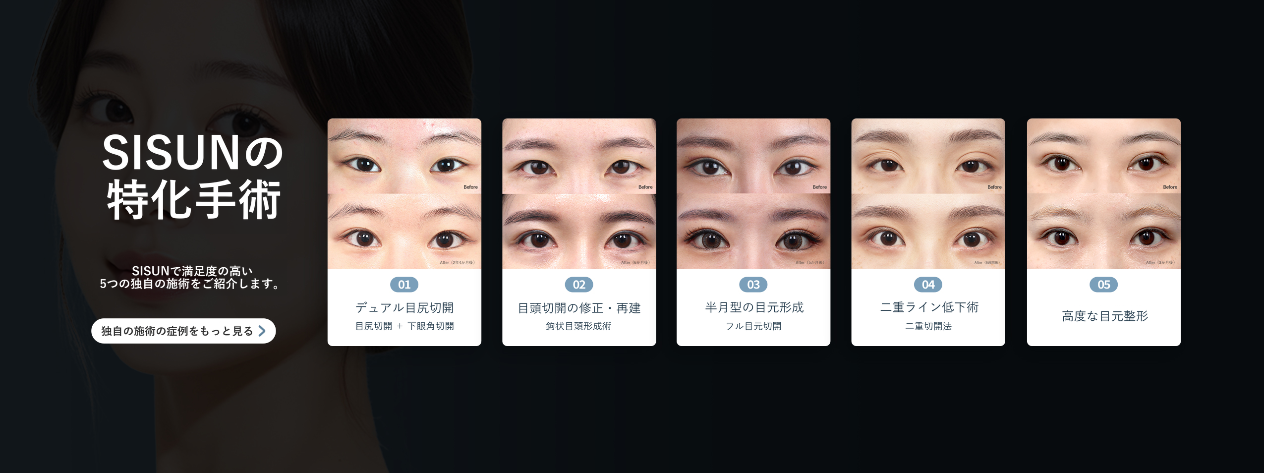 SISUN美容外科独自の目元手術