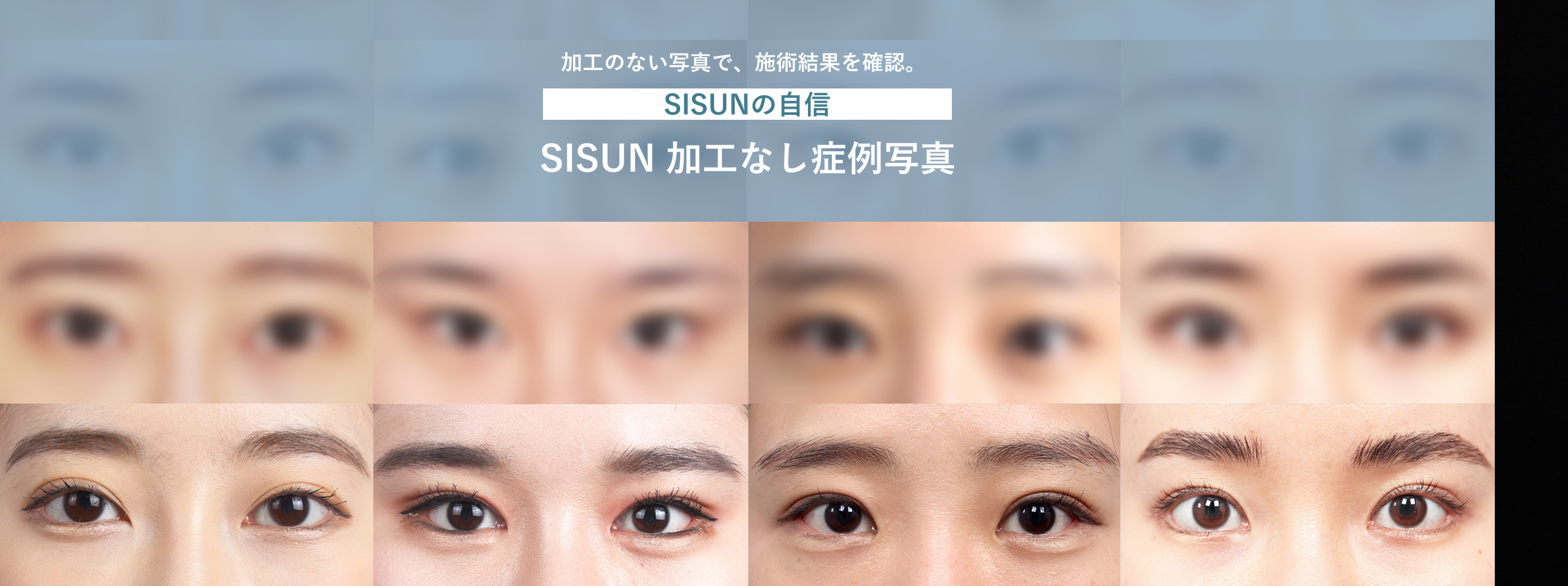 SISUN美容外科の加工なし施術前後写真