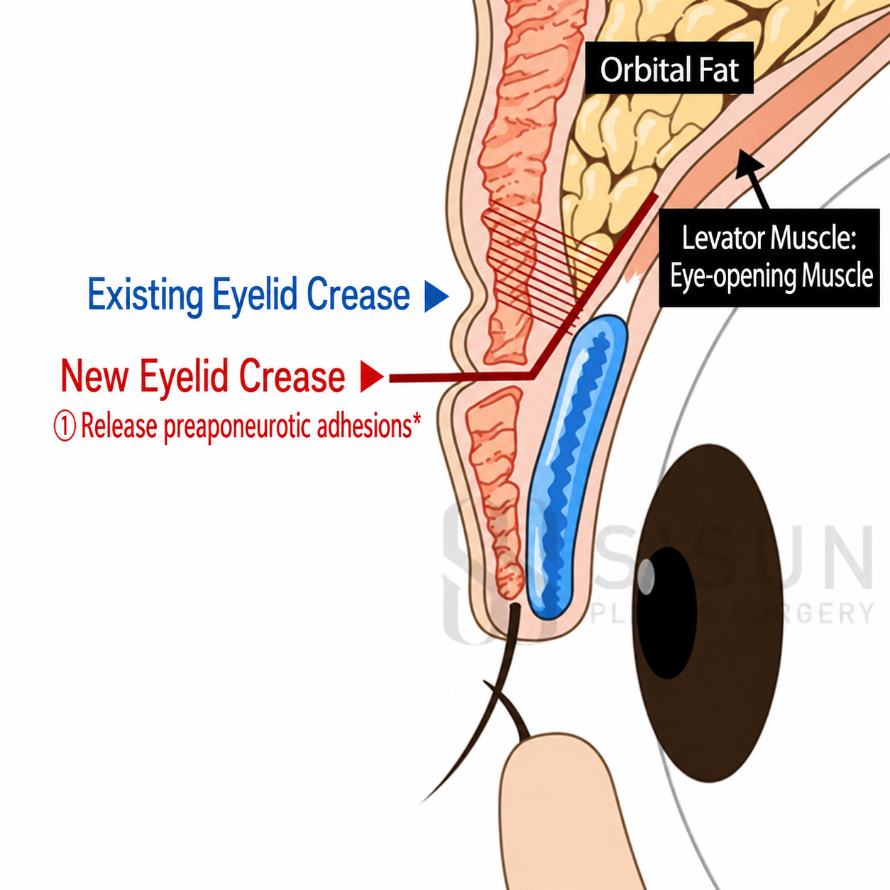 Crease lowering: existing and new eyelid crease, orbital fat and levator muscle